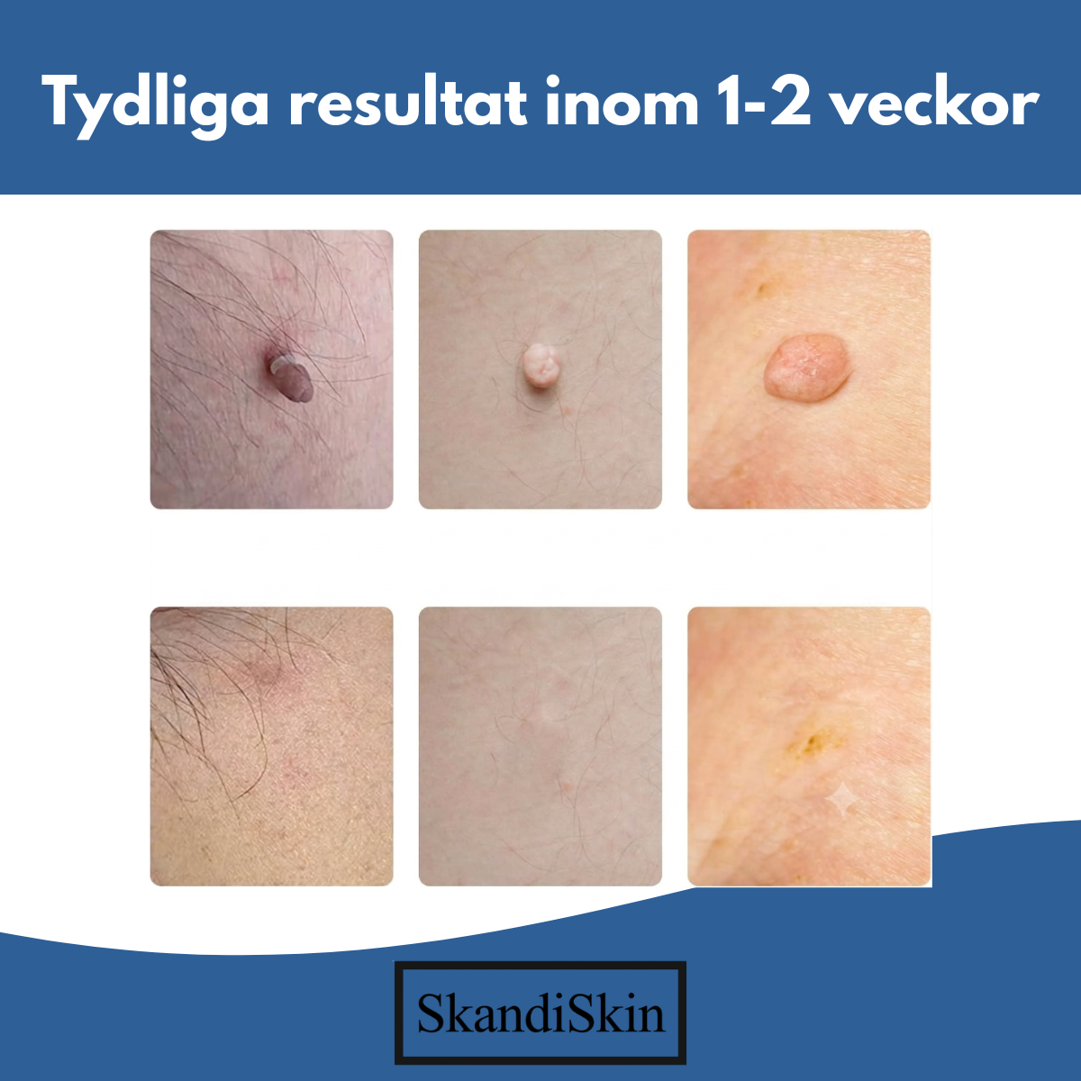 SkandiSkin™ - Hudfliksborttagare