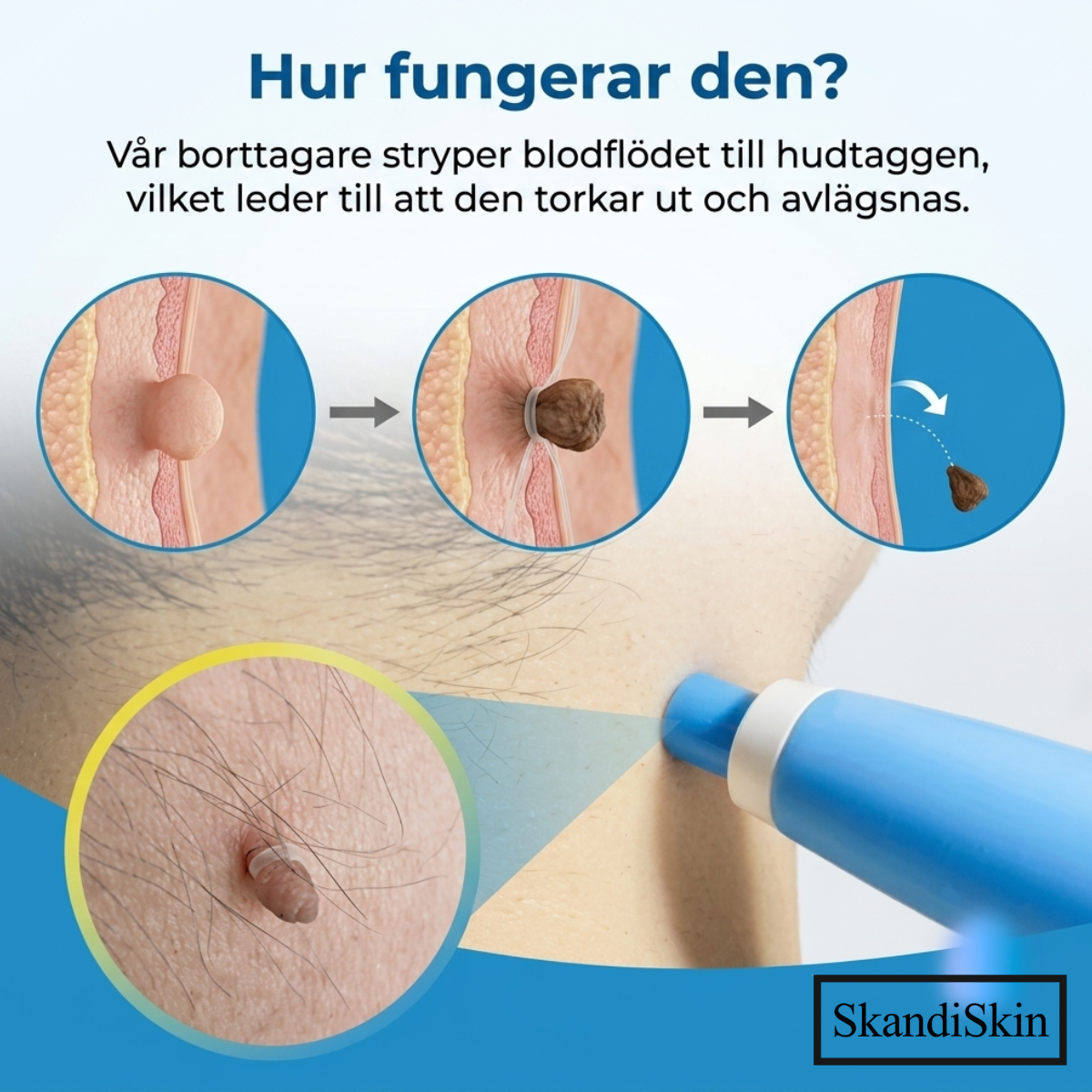 SkandiSkin™ - Hudfliksborttagare