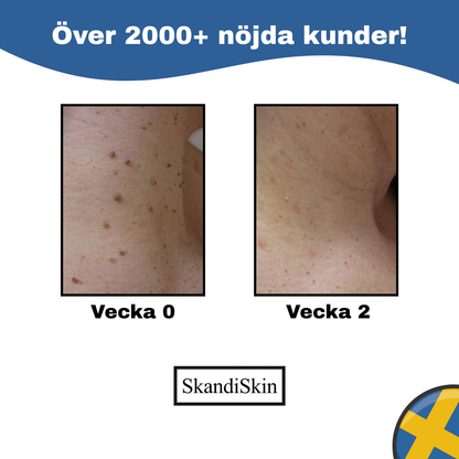 SkandiSkin™ - Hudfliksborttagare
